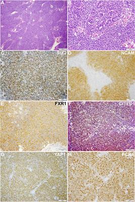 Exploiting embryonic niche conditions to grow Wilms tumor blastema in culture